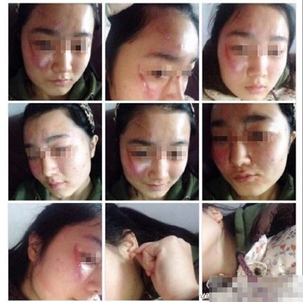 曝湖北应城一中学女学生被老师打致毁容 老师拿书砸学生脑袋|微博
