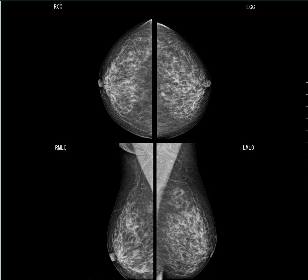 【2018 红点奖】MAMMOMAT Revelation / 乳房X射线摄影系统 - 普象网