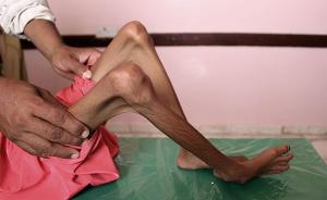 也门战争已致8.5万名儿童饿死，统计数据或是“冰山一角”