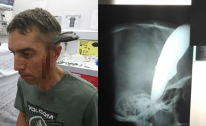南非一男子遇劫头部被插长刀，勇敢击退恶徒并骑车就医