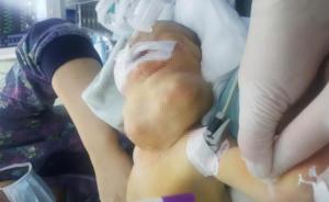 新生兒頸部掛另一個(gè)“腦袋”呼吸困難，實(shí)為巨大腫瘤來(lái)滬切除