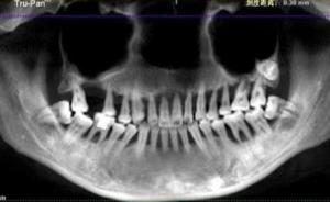 轻度牙周炎6年发展为重度，90后姑娘上半口牙全松动被拔光