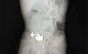 宁波4岁男童吞20颗磁力珠致小肠多处穿孔，手术4小时修复