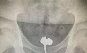 11岁男孩将70颗磁力珠塞入自己尿道，医生呼吁家长别再买