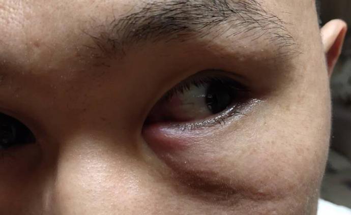 南京一男子做完足疗接受“眼部按摩”次日双眼发炎，获赔五百