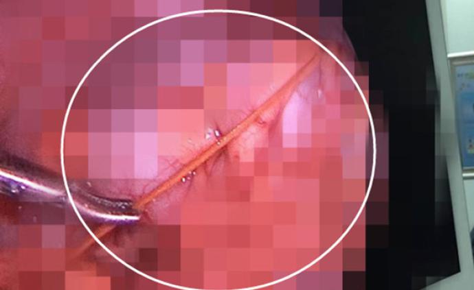 苏州5岁女童被凉席竹刺扎中，6厘米竹刺入腹腔手术取出
