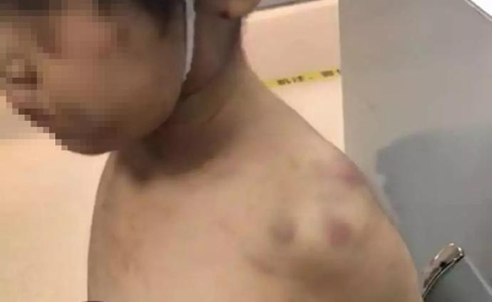 杭州6岁女童疑遭奶奶虐打“浑身伤”，警方：在解决抚养问题