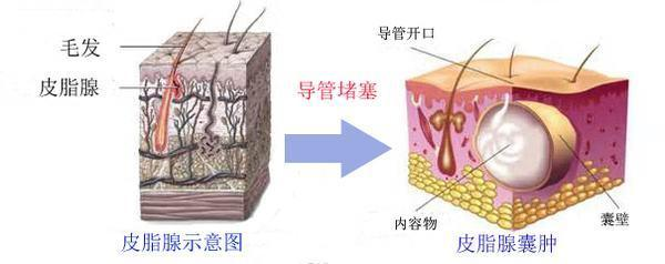 科普｜经常长痘痘？这种常见的皮肤现象了解一下  第2张