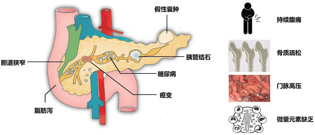 消化道里的“世界难题”