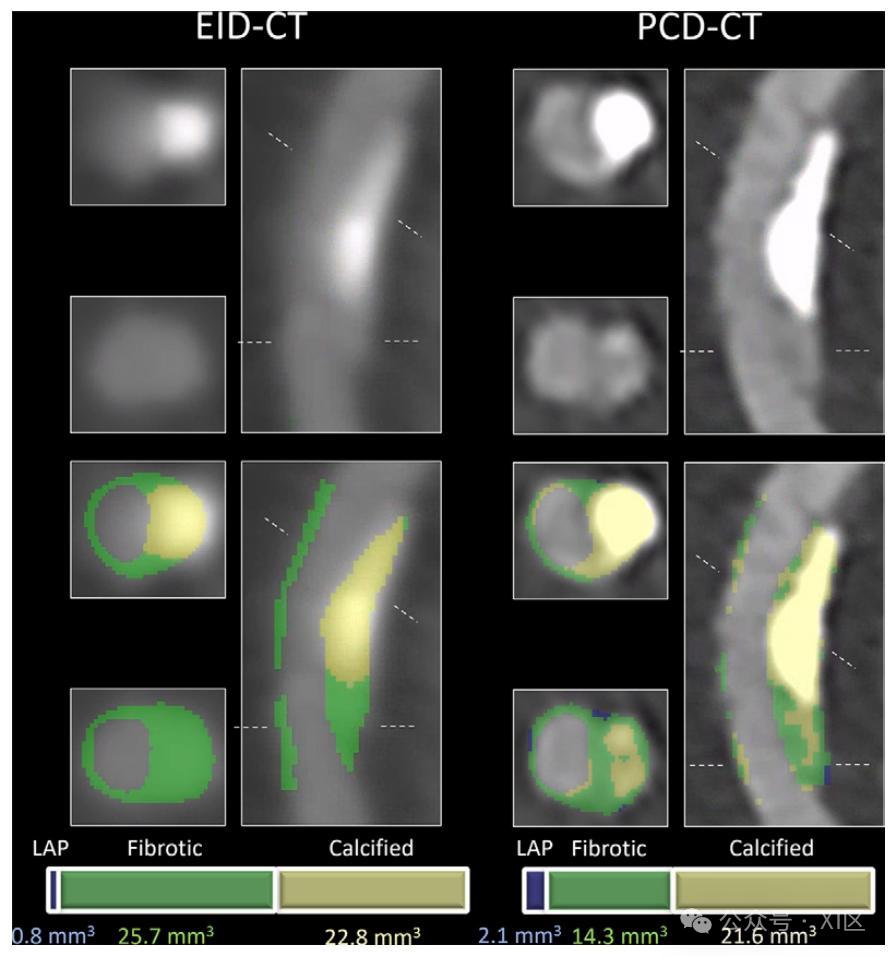 Radiology：UHR-PCCT在冠状动脉斑块定量评估中的价值