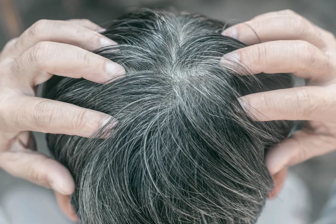 白头发还能“黑回去”？做对这几件事，真的有可能