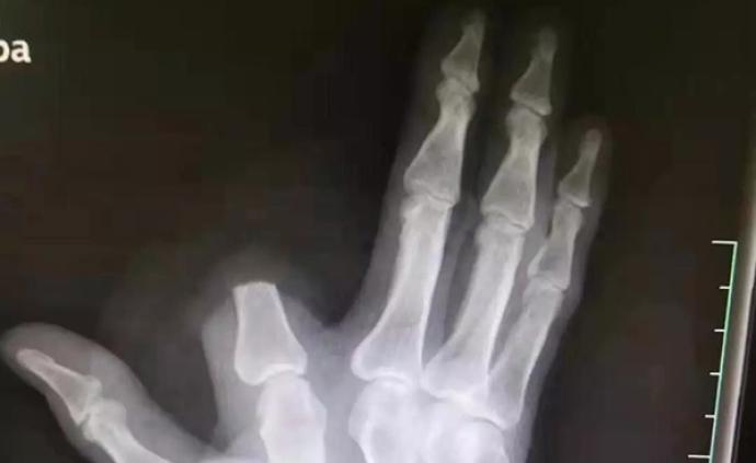 杭州男子被五步蛇咬伤后一刀斩断手指，医生：完全没必要