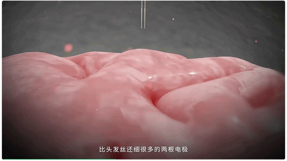 比马斯克Neuralink工艺更先进!我国成功开展首例侵入式脑机接口临床试验