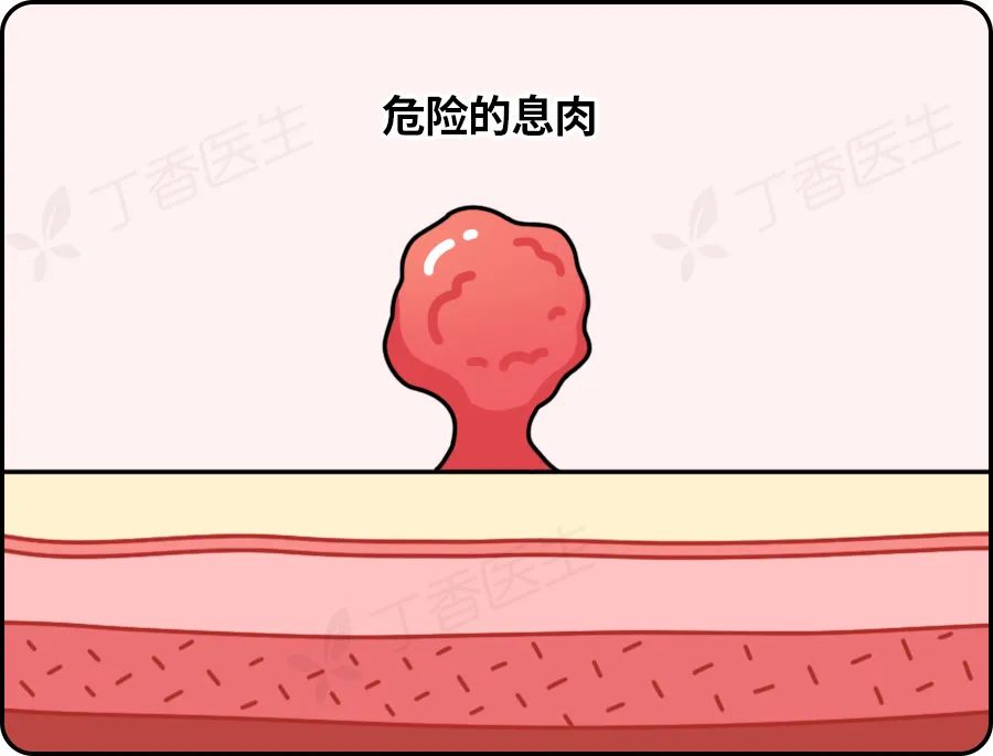 发现就是中晚期的肠癌,一个方法就可以避免
