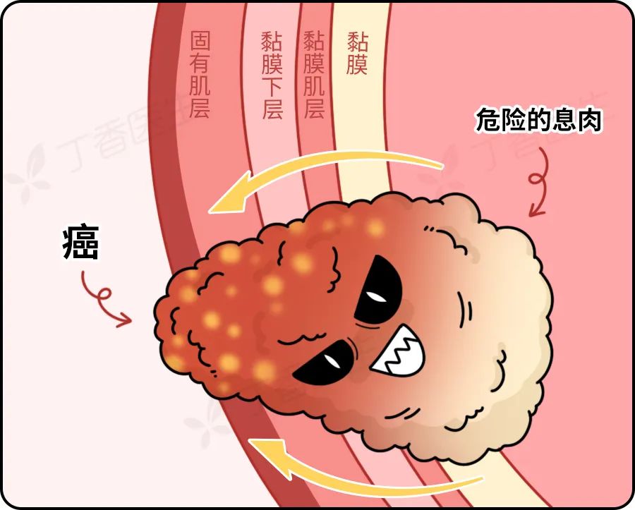 发现就是中晚期的肠癌,一个方法就可以避免
