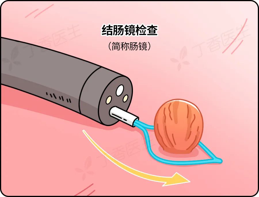 发现就是中晚期的肠癌,一个方法就可以避免