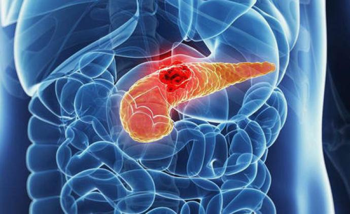 中国科学家给出定论，胰腺癌恶变“元凶”被发现