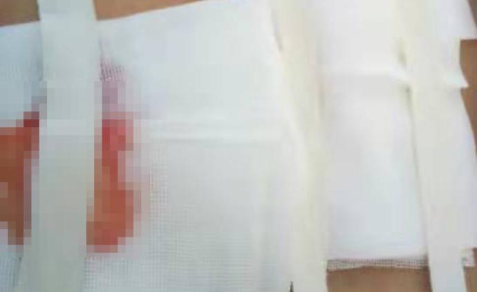 杞县115人针灸后皮肤溃烂：或医源感染，警方询问涉事村医