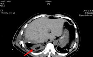 徐医附院回应男子术后右肾失踪：术后2次CT均显示右肾存在