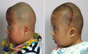 上海医生为8个月大狭颅症患儿重拼颅骨，小“外星人”变可爱