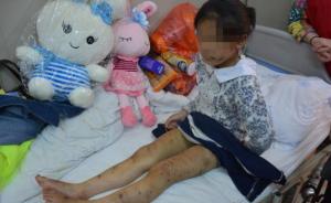 四川一10岁女童遭养母虐待浑身是伤，警方对其养母行政拘留