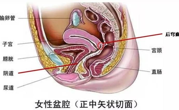 除了宫颈癌，高危型HPV持续感染还会引起阴道癌