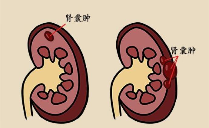 长了囊肿不痛不痒，会不会癌变？要不要切除？