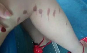网曝福建多名短裙女性被泼液体留疤痕，警方：正调查是否属实