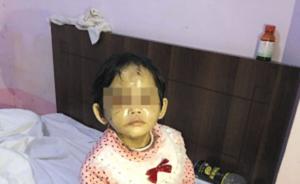 昆明一2岁女童被遗留宾馆，满身伤痕累累疑遭虐待