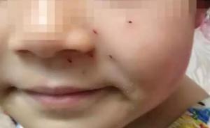 河南一女童培训班上答不出题，被老师用铅笔在脸上扎了6个洞