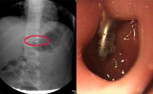 浙江五岁男孩误食三块磁石，上海医生用“圈套器”从肠道取出