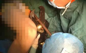 深圳一工人摔倒被钢筋贯穿身体，医院请6名消防官兵协助手术