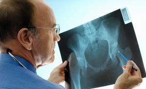 30岁患骨质疏松很常见 警惕背痛，适度运动预防骨丢失