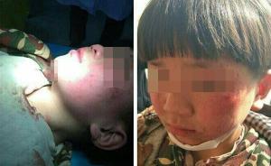 临沂8岁男孩被指长期遭养母虐待多处受伤，警方调查