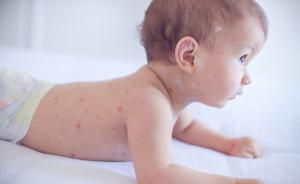 春季水痘高发，皮肤科专家解答儿童发痘疑问