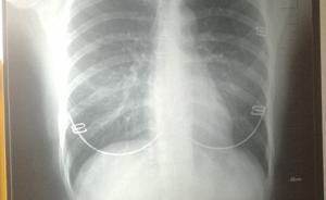 苏州男子胸片被弄错为女性，一年后确诊肺癌晚期医院否认漏诊
