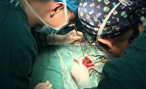 历经4小时手术，上海援疆医生为莎车女孩摘除巨大脑瘤