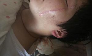 河北一中学班会课起冲突：一学生被同学刀割双脸，老师不在场