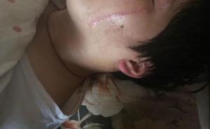 河北隆尧回应一中学生遭割脸：情况属实，校长被警告处分