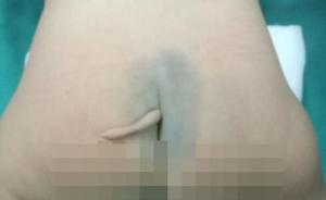安徽一5个月大女婴长尾巴，专家诊断不是返祖是“有尾畸形”