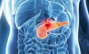 胰腺癌研究获最新突破：肿瘤生长机制被发现，可被显著抑制