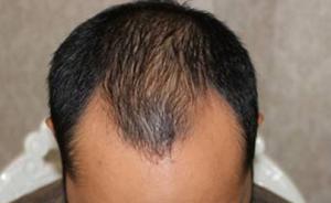 美国科学家发现头发生长与免疫细胞有关，治疗秃顶有了新希望