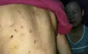 安徽一8岁女童遭生母虐待浑身伤痕，警方：其母被行拘8日