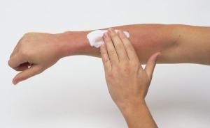 烈日炎炎皮肤易受伤，中医如何防治汗斑痱子和晒伤