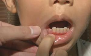 广州一小学生被老师用铁尺扇脸打掉一颗牙，校方：会处理 