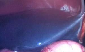 湖北恩施医生手术发现患者肝脏为蓝色，业内研判系纹身引起