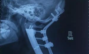 世界首例：长征医院用3D打印将患者全颈椎椎体换为钛合金