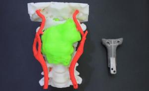 脖子也能靠打印置换了？3D打印技术助医生闯过手术禁区