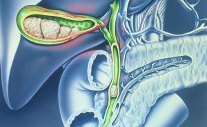 胆疼未必是胆囊结石作怪，这个结石更可怕