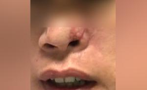 同学聚会发酒疯,劝架男子被咬掉鼻子